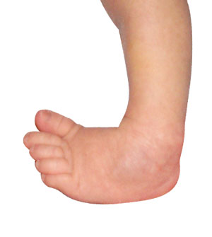 Congenital Deformity and Clubfoot