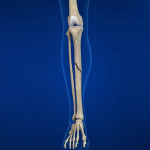Tibia Fracture 