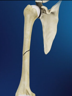 Mid-Shaft Humerus Fracture