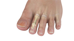 Toe Fractures